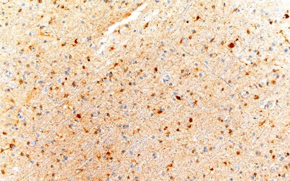 10C (Case 10) IDH1 20X