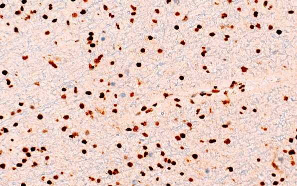 10D (Case 10) ATRX 40X