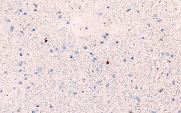 10E (Case 10) p53 40X