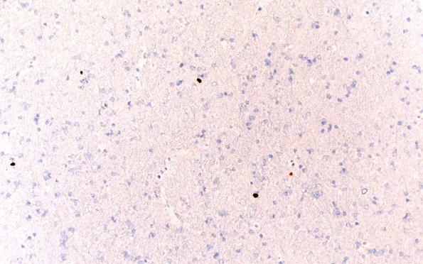 10F (Case 10) Ki67 20X