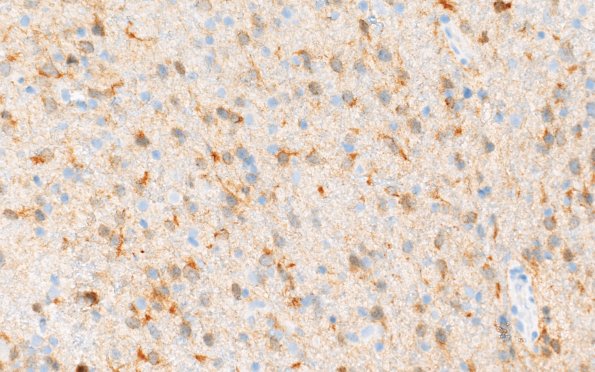 12B (Case 12) IDH 40X