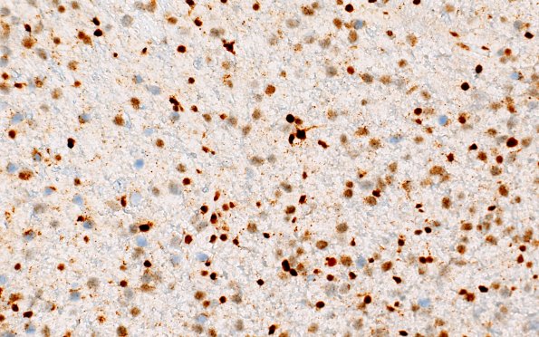 12C (Case 12) ATRX 40X