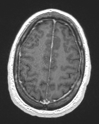 15A2 (Case 15) T1W - Copy