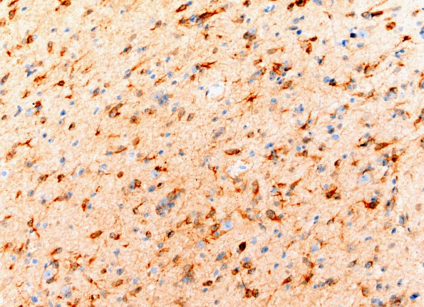 15C1 (Case 15) IDH 20X