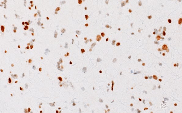 15D (Case 15) ATRX 40X