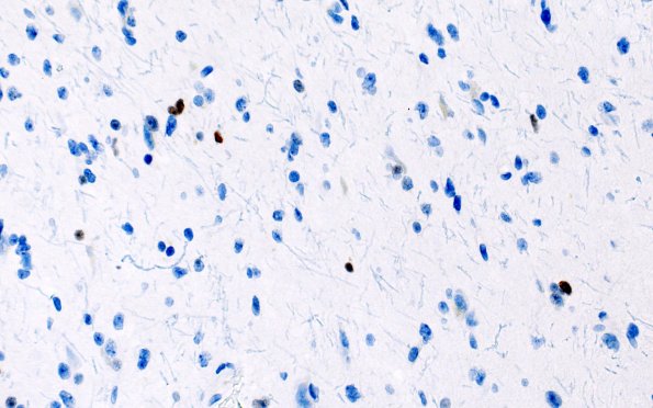 15E (Case 15) p53 40X