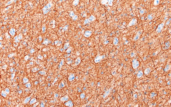 15F (Case 15) NF 20X