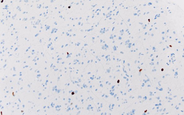 15H (Case 15) Ki67 20X