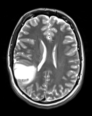 17A1 (Case 17) T2W - Copy