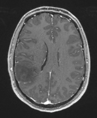17A2 (Case 17) T1W - Copy