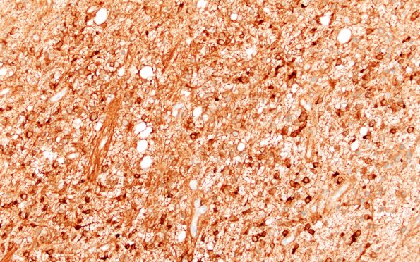 17C1 (Case 17) IDH 20X