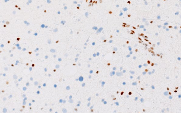 17D (Case 17) ATRX 40X