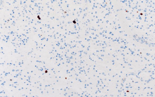 17F (Case 17) Ki67 20X