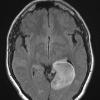 3A1 Astrocytoma, Gr II (Case 3) FLAIR - Copy