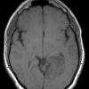3A2 Astrocytoma, Gr II (Case 3) T1 noC 2 - Copy