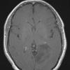 3A3 Astrocytoma, Gr II (Case 3) T1W 2 - Copy