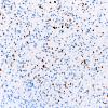 3FAstrocytoma, Gr II (Case 3) p53 20X 1