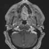 5A7 Astrocytoma Gr 2 (Case 5) T1W - Copy