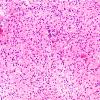 5B1 Astrocytoma Gr 2 (Case 5) H&E 20X