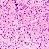 5B2 Astrocytoma Gr 2 (Case 5) H&E 40X