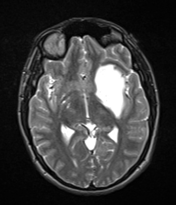 7A1 (Case 7) T2W - Copy