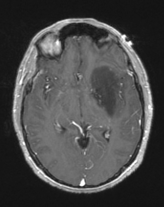 7A2 (Case 7) T1W - Copy