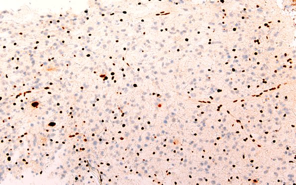 7C1 (Case 7) ATRX 20X