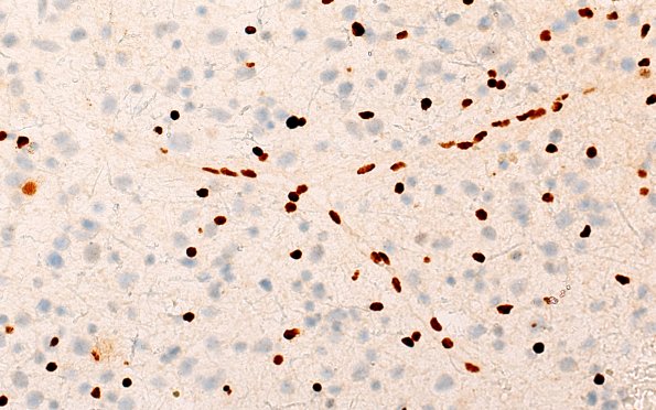 7C2 (Case 7) ATRX 40X