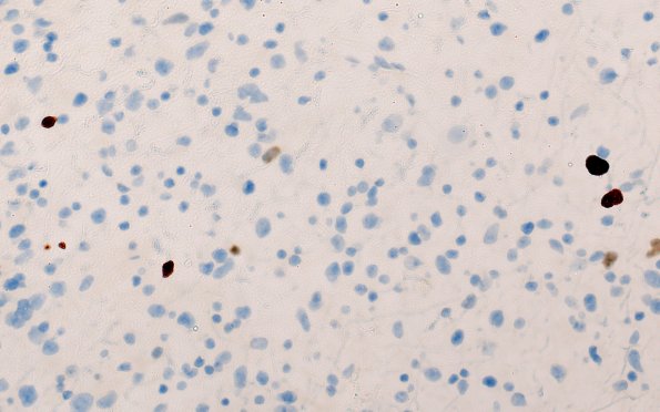 7D (Case 7) Ki67 40X