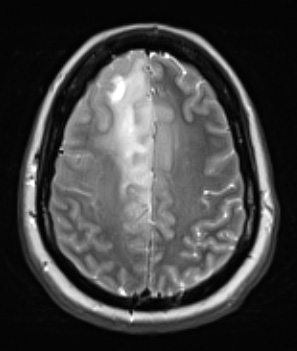 8A1 (Case 8) T2W - Copy