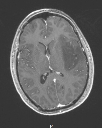 9A2 (Case 9) T1W - Copy