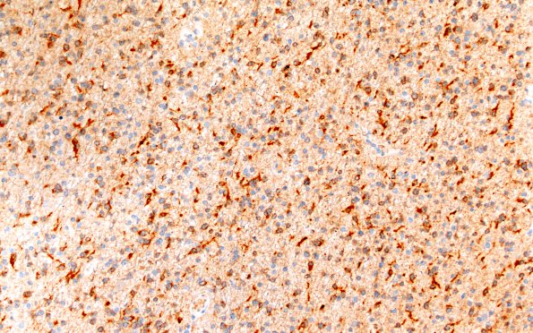 9D1 (Case 9) IDH1 20X