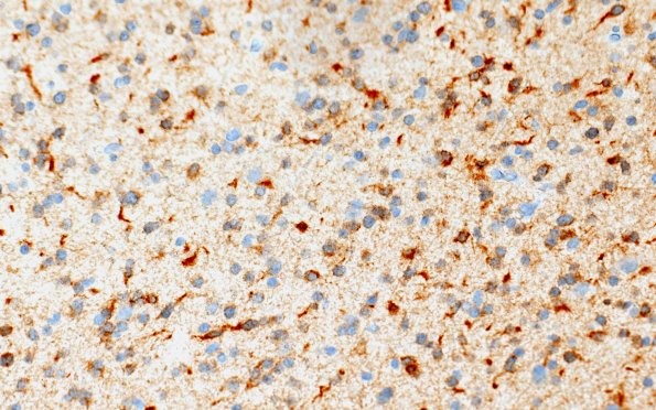 9D2 (Case 9) IDH1 40X