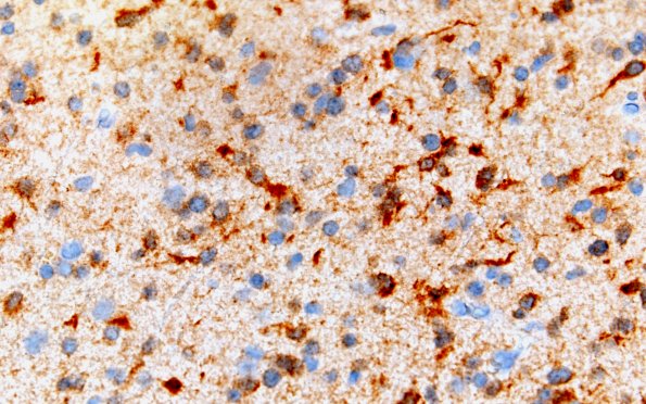 9D3 (Case 9) IDH1 60X