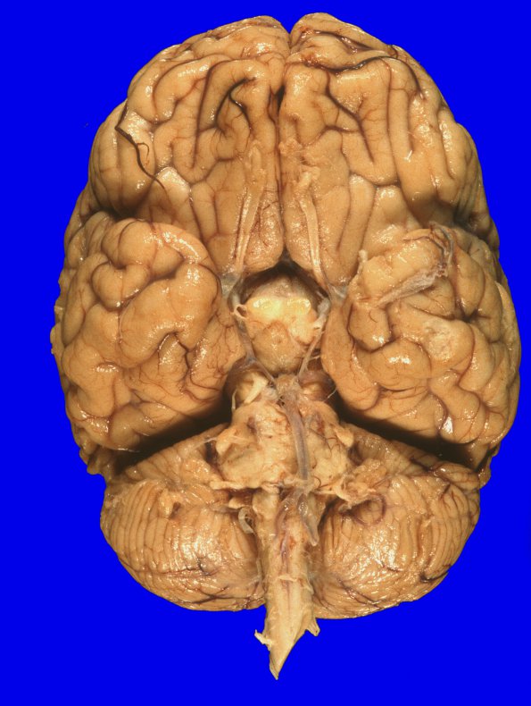 10A1 Is DMG by IHC GBM (Case 10) 10