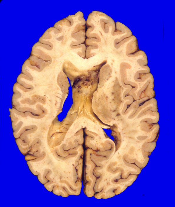 10A3 GBM (Case 10) A1