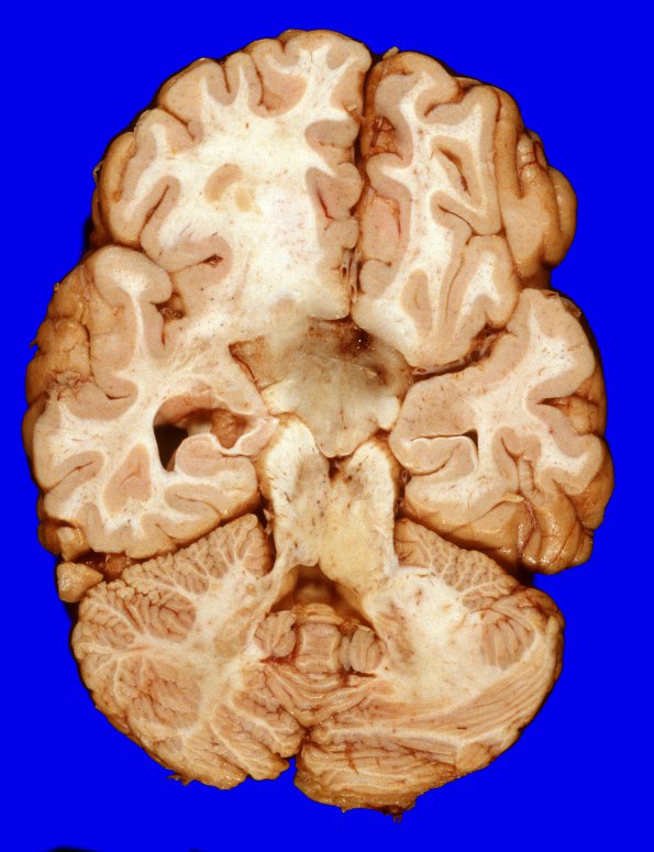 10A4 GBM (Case 10) 11A