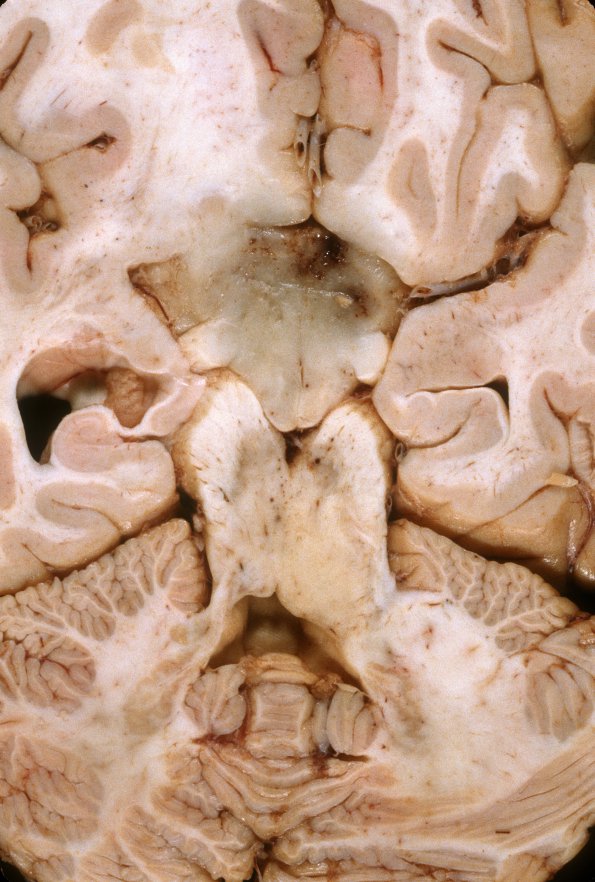 10A5 GBM (Case 10) 1