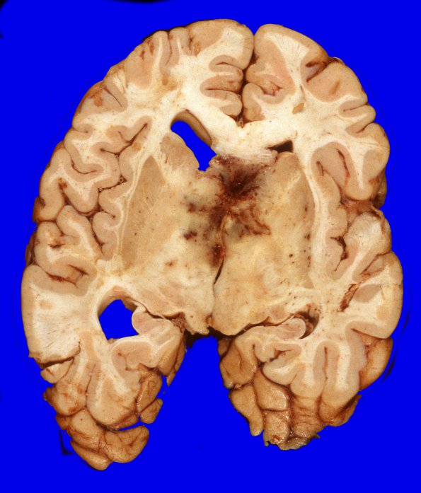 10A6 GBM (Case 10) 3