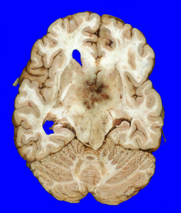 10A8 GBM (Case 10)  5A (2)