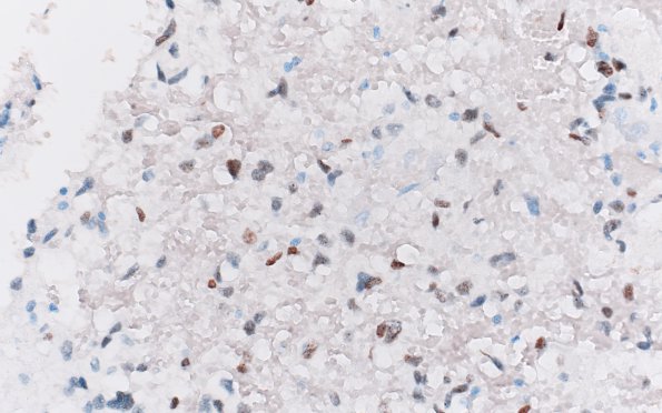 10C3 DMG (Case 10) H3K27M 40X