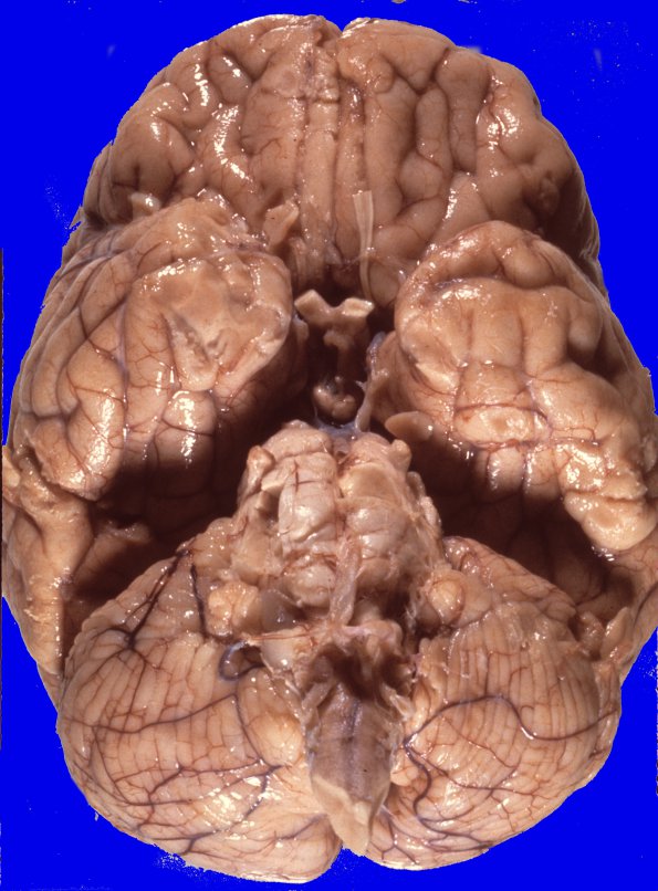 13A1 Glioblastoma (Case 13) Pons 1