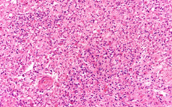 13B1 Glioblastoma (Case 13) H&E 20X