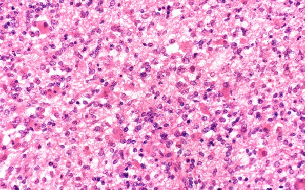 13B2 Glioblastoma (Case 13) H&E 40X