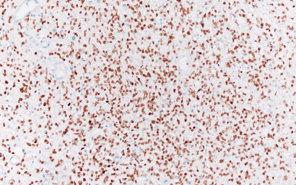 13C1 Glioblastoma (Case 13) H3K27M 20X - Copy