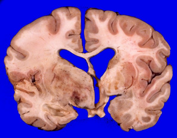 14A3 GBM (Case 14) 7