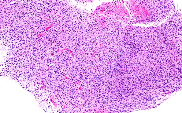 16B1 DMG (Case 16) H&E 10X