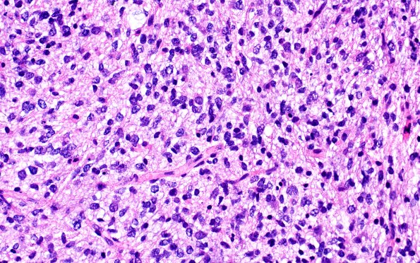 16B3 DMG (Case 16) H&E 40X 1