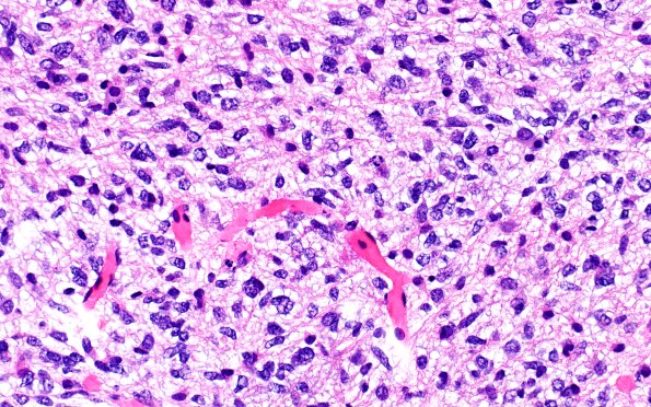 16B4 DMG (Case 16) H&E 40X 3