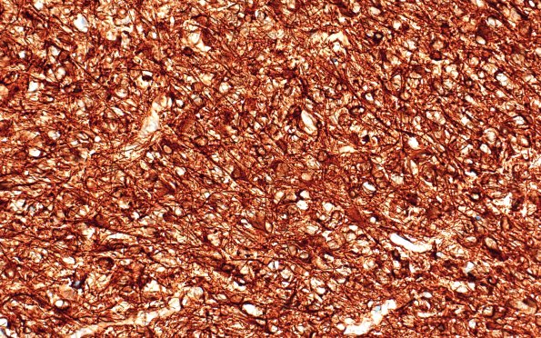 16D DMG (Case 16) GFAP 40X 1